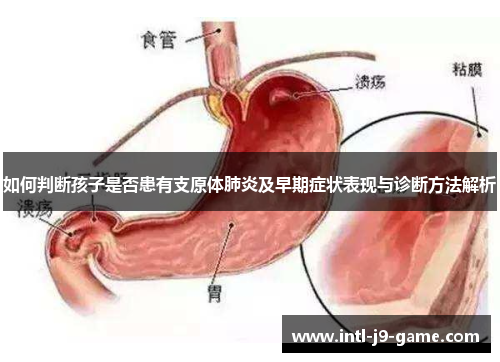如何判断孩子是否患有支原体肺炎及早期症状表现与诊断方法解析 如何判断孩子是否患有支原体肺炎及早期症状表现与诊断方法解析
